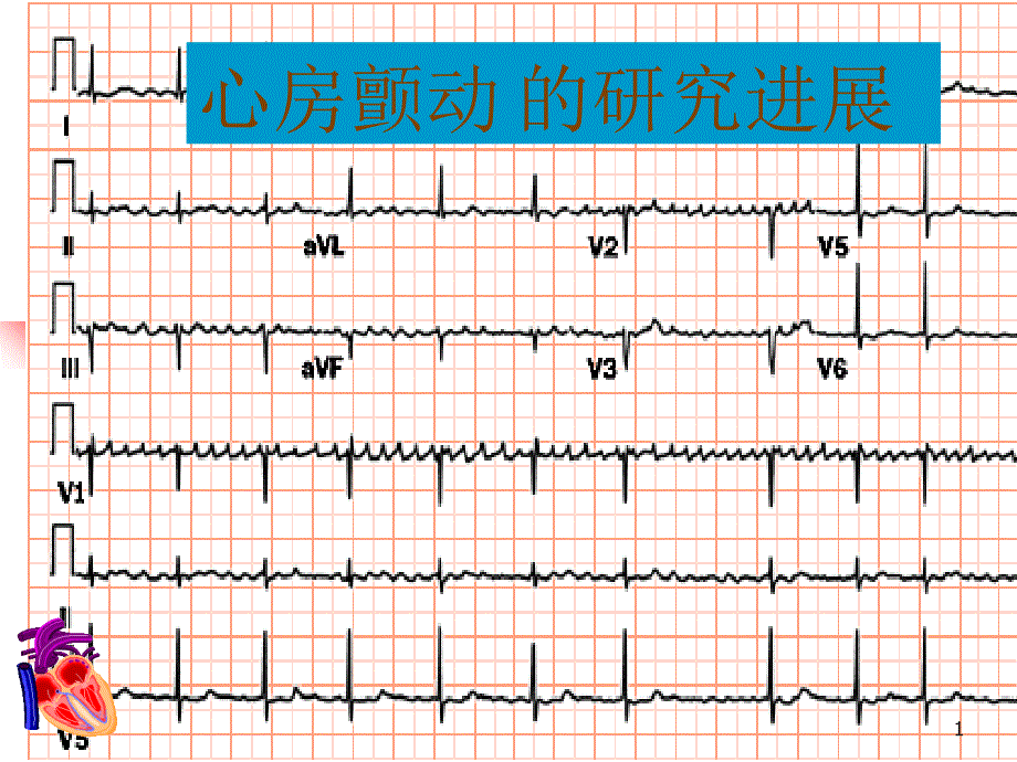 心房颤动的研究进展_第1页
