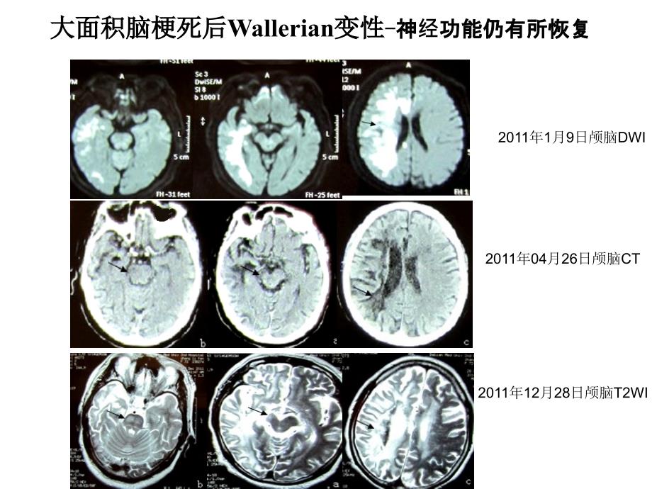 脑卒中后神经功能恢复的可能机制()_第1页