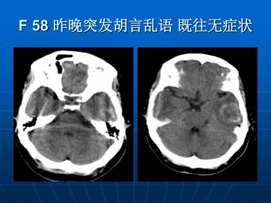 肿瘤卒中_第1页