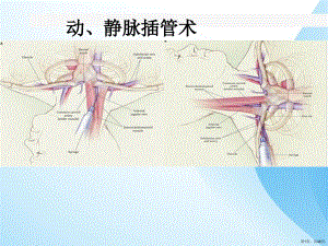 动静脉插管术课件(PPT 48页)