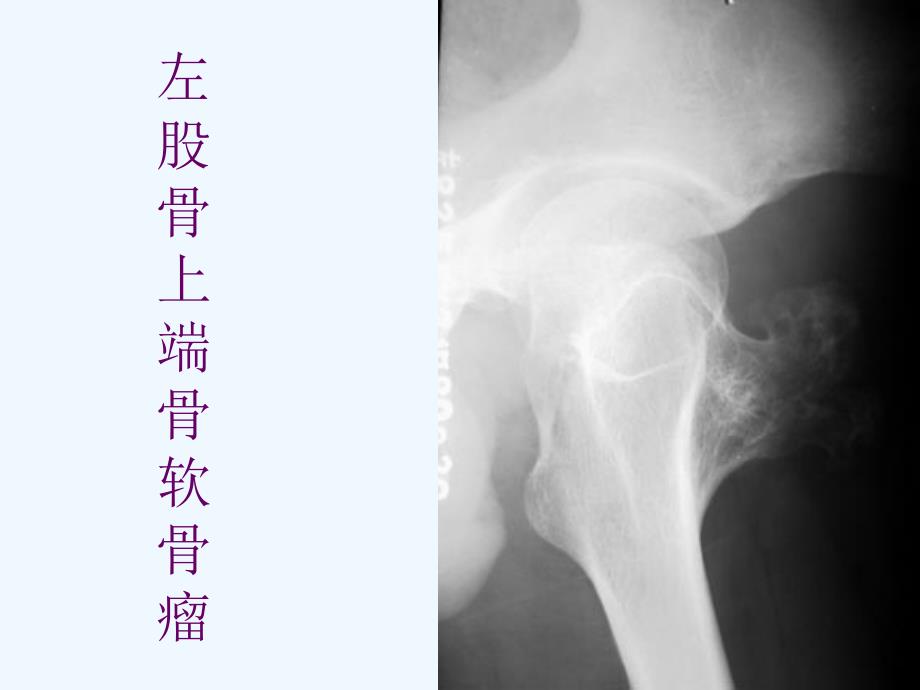 骨肿瘤X线病例图谱C_第1页