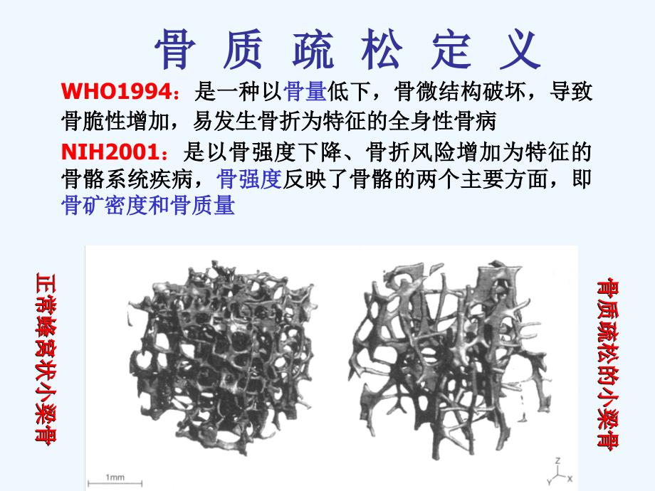 骨质疏松症中西医结合治疗_第1页