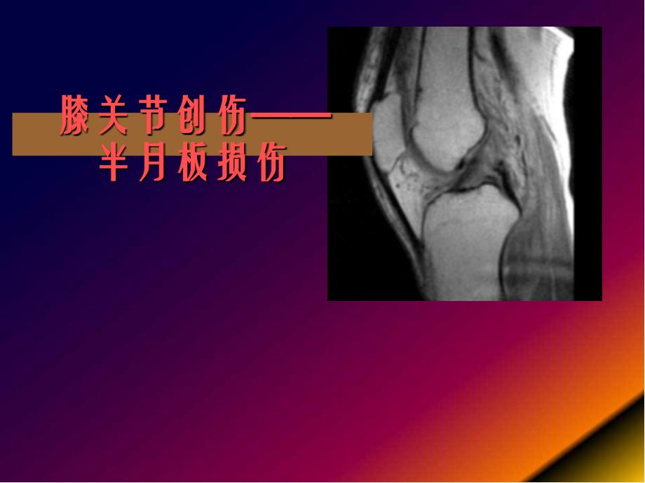 膝关节 损伤MR影像表现ppt参考课件_第1页