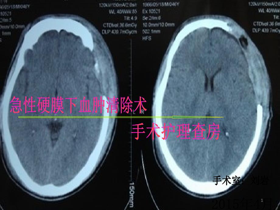 急性硬膜下血肿清除术刘岩ppt_第1页