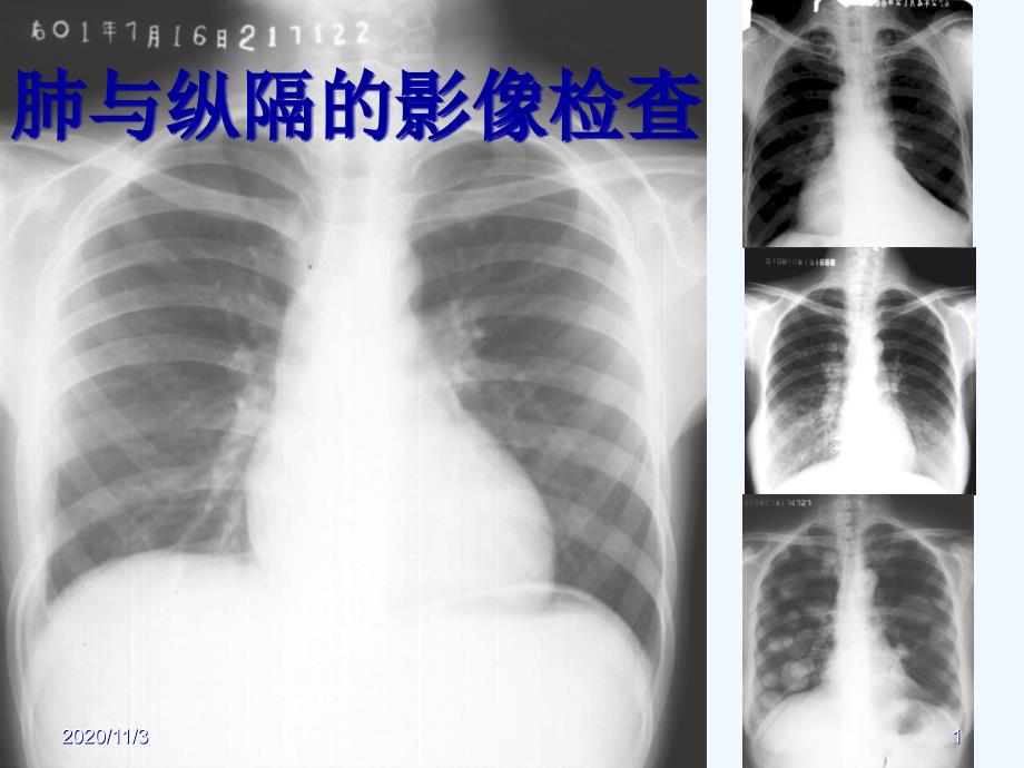 e诊断学看胸部CT_第1页