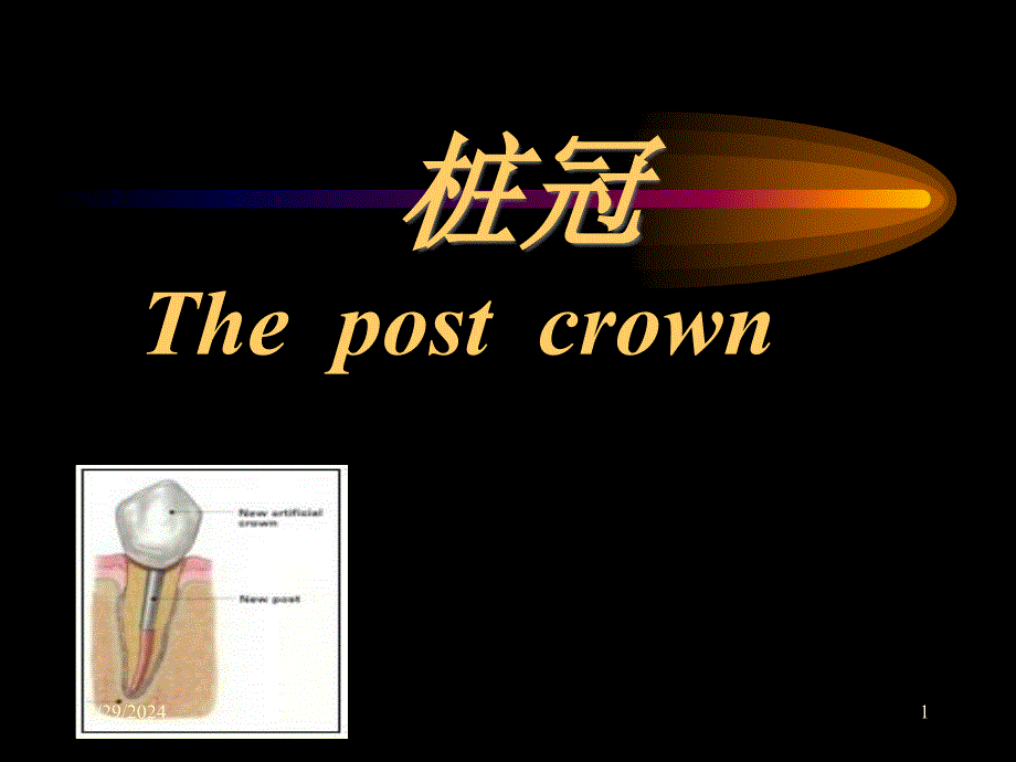 第八章桩冠和桩核冠概要1_第1页