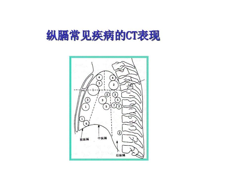 纵膈常见疾病CT表现_第1页