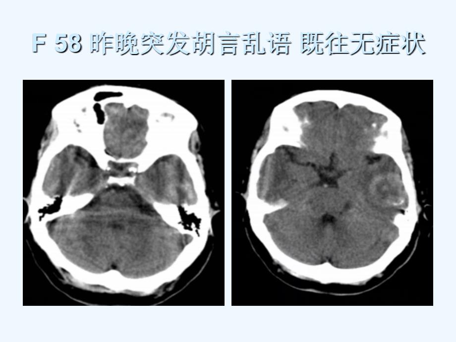 肿瘤卒中_第1页