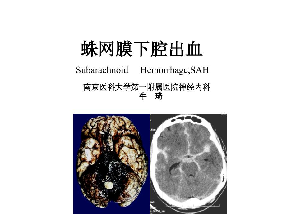 蛛网膜下腔出血教案_第1页