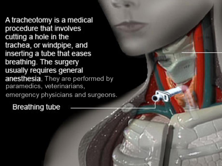 气管切开术(Tracheotomy)_第1页