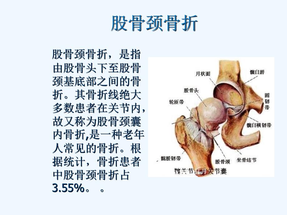 浅谈股骨颈骨折幻灯_第1页