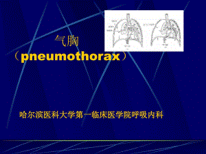 气胸pneumothorax