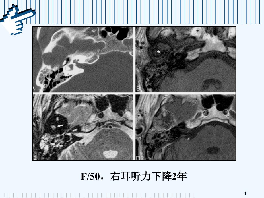 颞骨巨细胞修复性肉芽肿_第1页