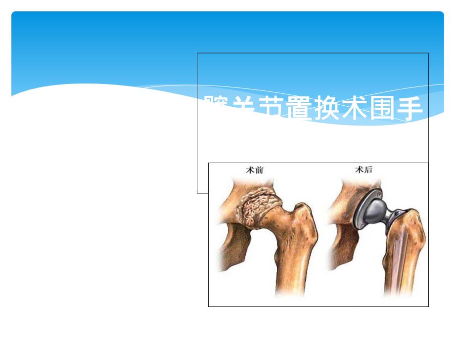 髋关节置换术围手术期护理_第1页