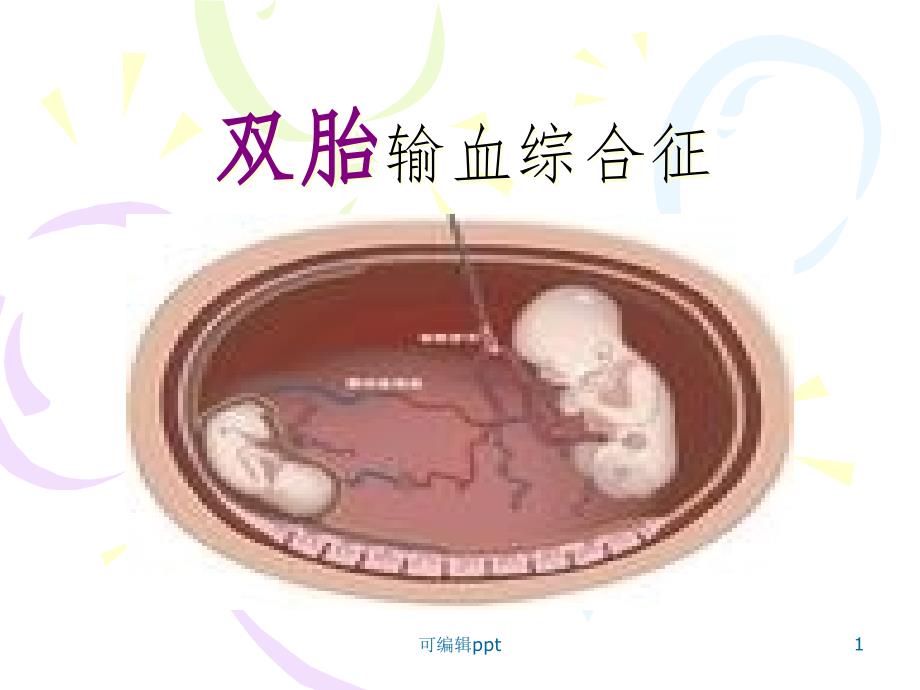 双胎输血综合症课件_第1页