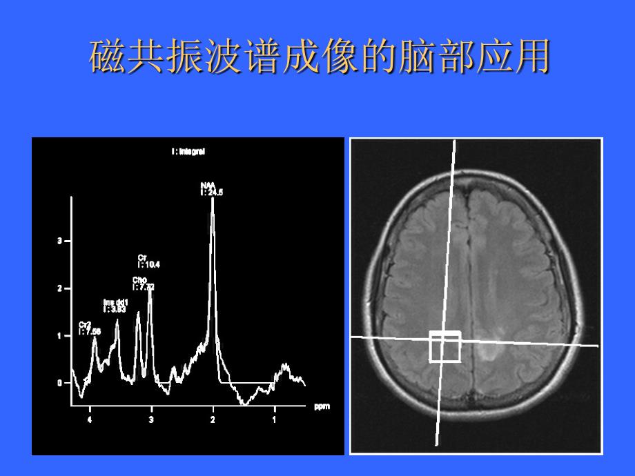 磁共振波谱成像的脑部应用_第1页