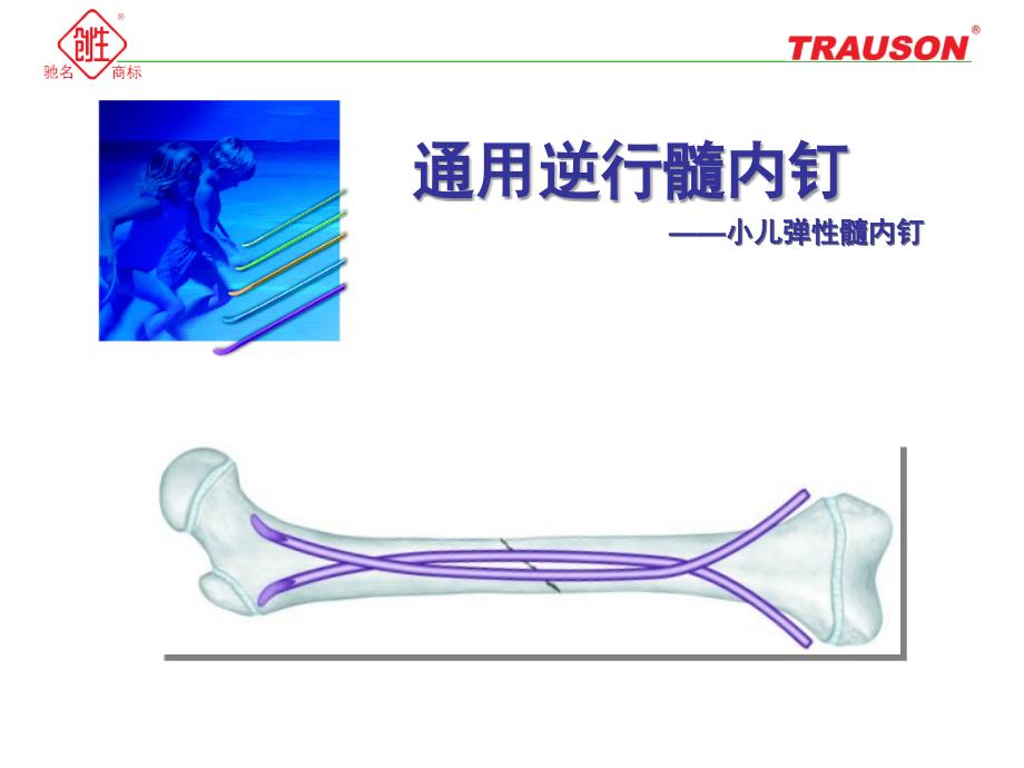 逆行髓内钉—小儿弹性髓内钉_第1页