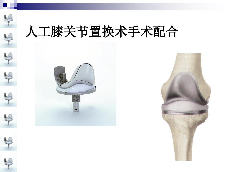 人工膝关节置换术手术配合课件_第1页