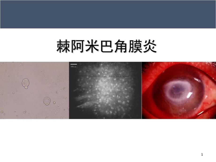 棘阿米巴角膜炎课件_第1页