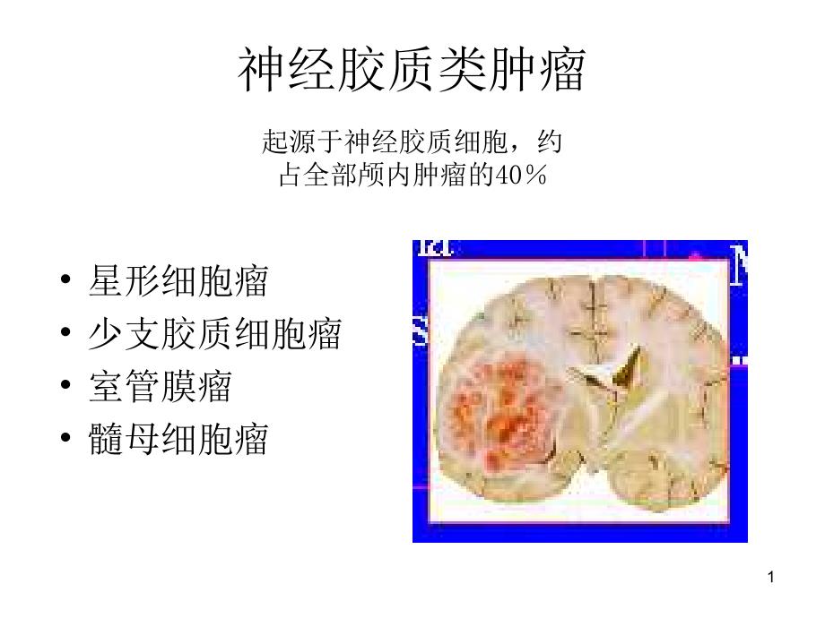 星形细胞瘤CT诊断课件_第1页