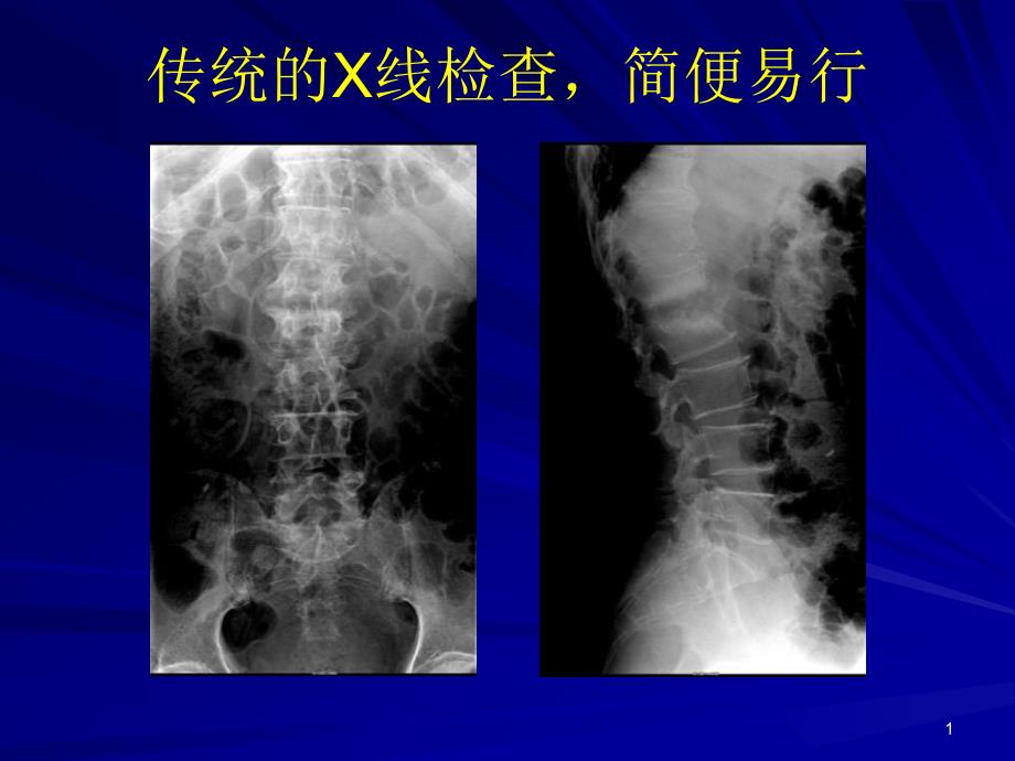 侯代伦骨关节结核影像学诊断课件_第1页