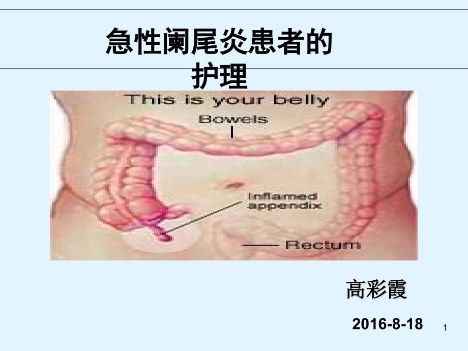 急性阑尾炎患者的护理-课件2_课件_第1页