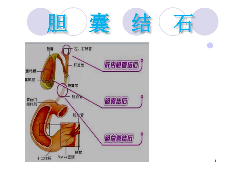 胆囊结石护理ppt课件_第1页