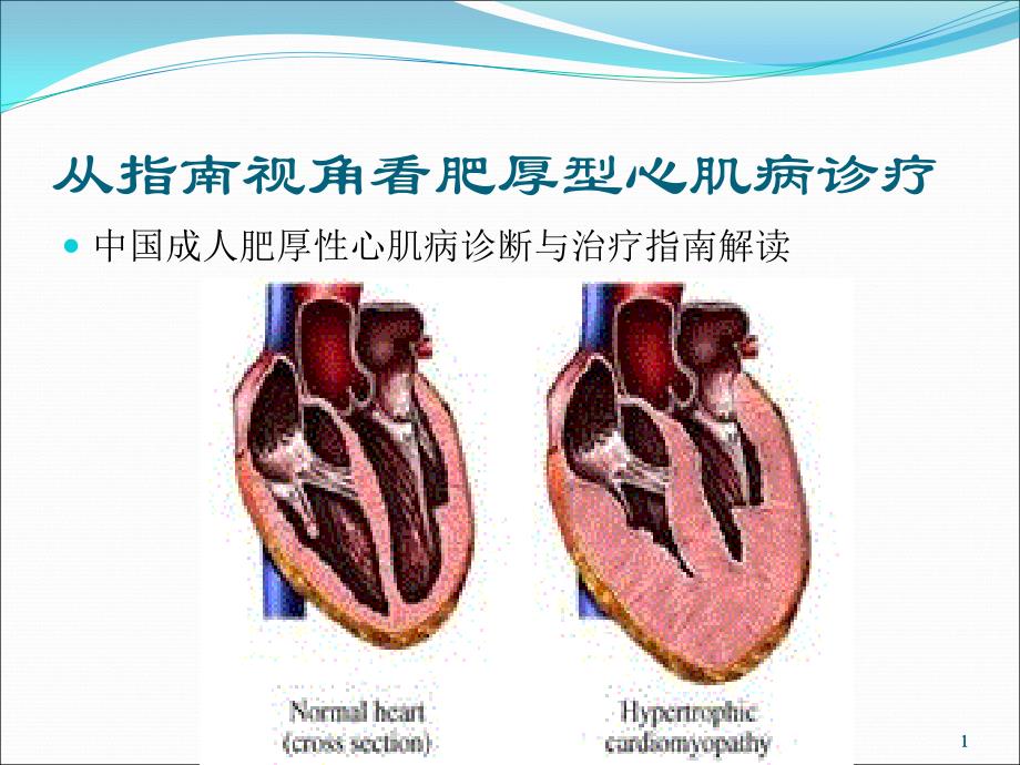 成人肥厚型心肌病诊断与治疗课件_第1页