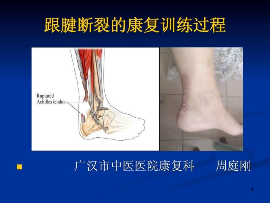 跟腱断裂的康复_1461777352[资料]课件_第1页