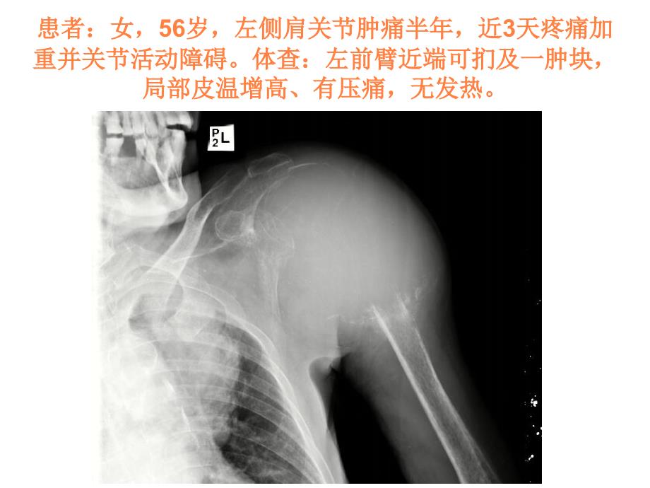 骨肉瘤X线诊断课件_第1页