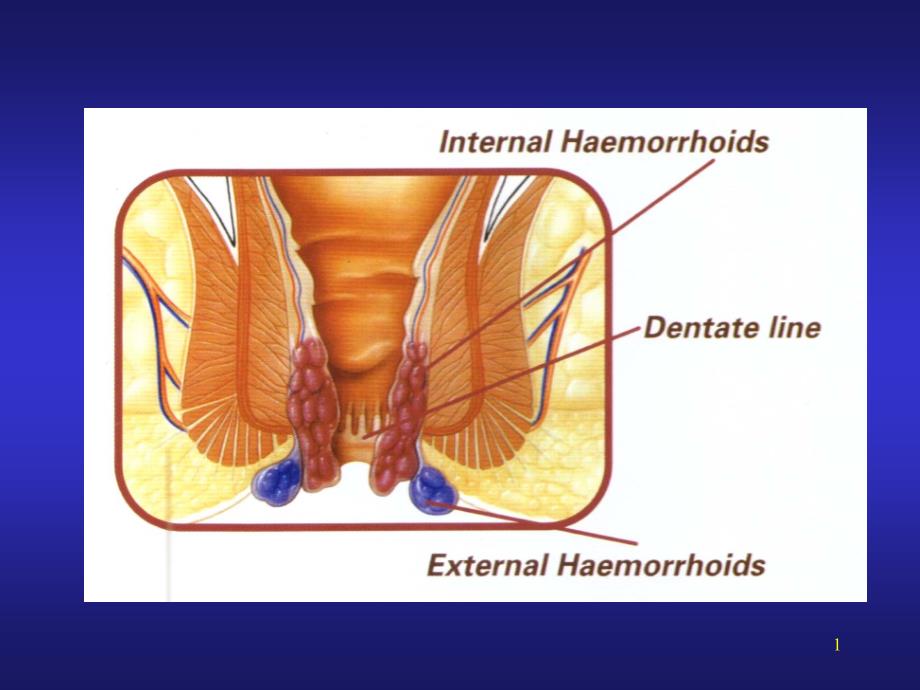结、直肠与肛门疾病疾病 - 上海第二医科大学课件_第1页
