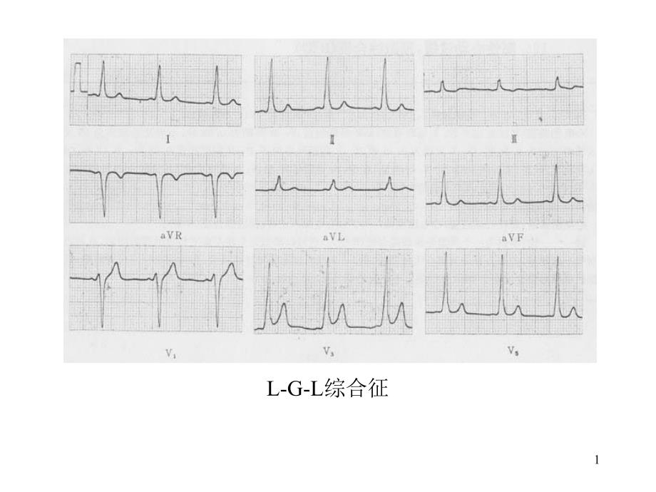 心电图演示文稿3_第1页