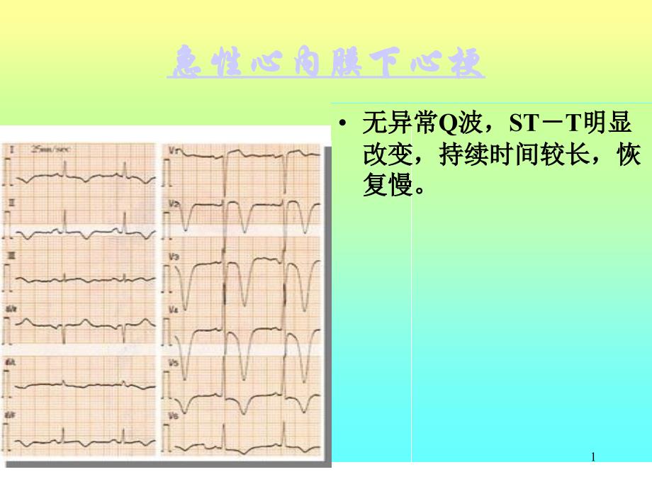 心电图演示文稿4_第1页