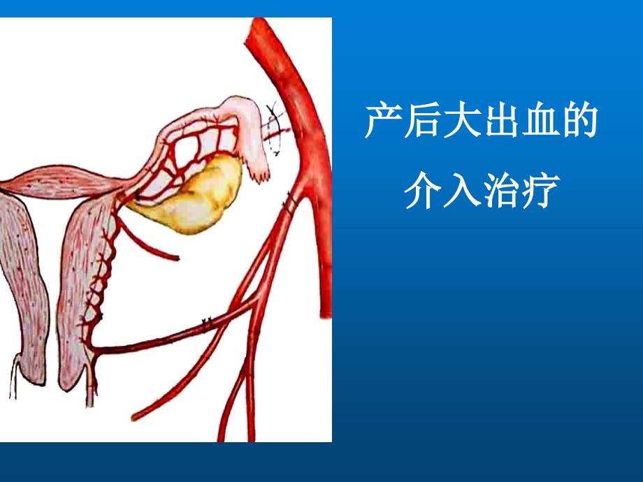 产后大出血的介入治疗课件_第1页