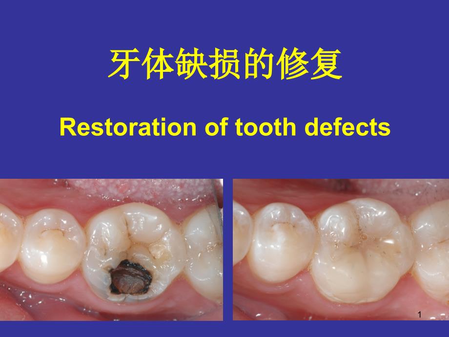 牙体缺损的修复课件_第1页