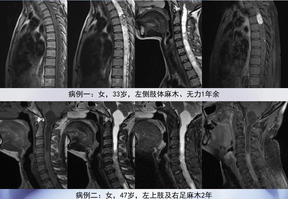 椎管内血管母细胞瘤课件_第1页