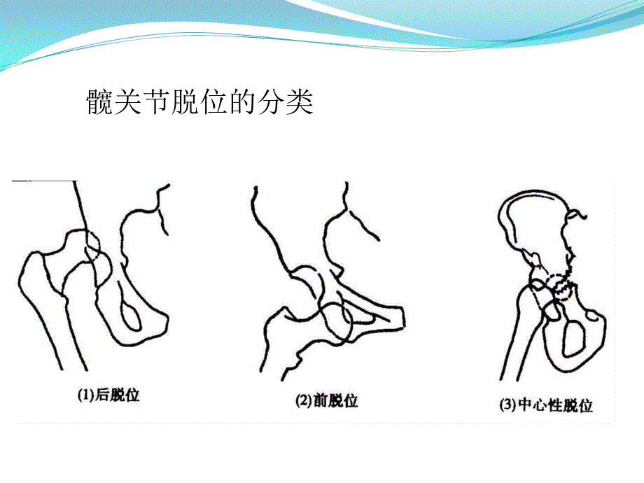 髋关节脱位手法复位课件_第1页