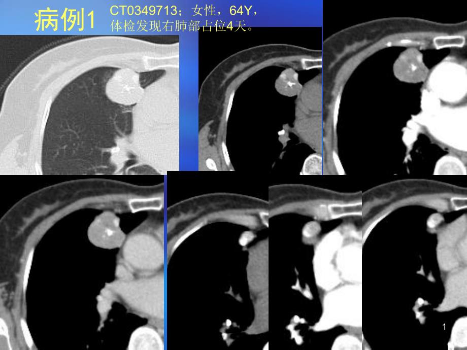 肺部错构瘤ct鉴别诊断病例随访课件_第1页