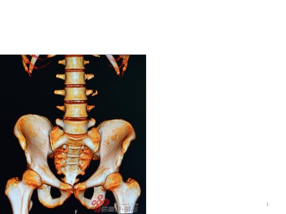 CT椎体的各类病变-课件_第1页