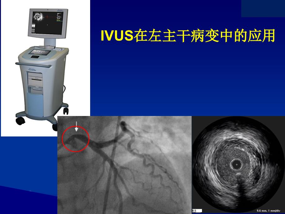 IVUS在左主干病变中的应用-课件_第1页