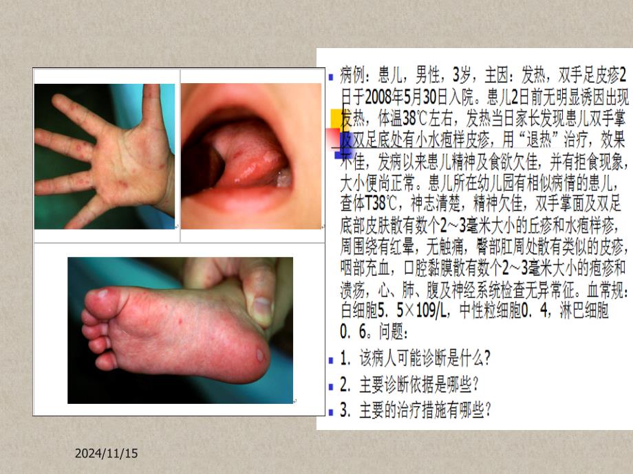 《手足口病》课件_第1页