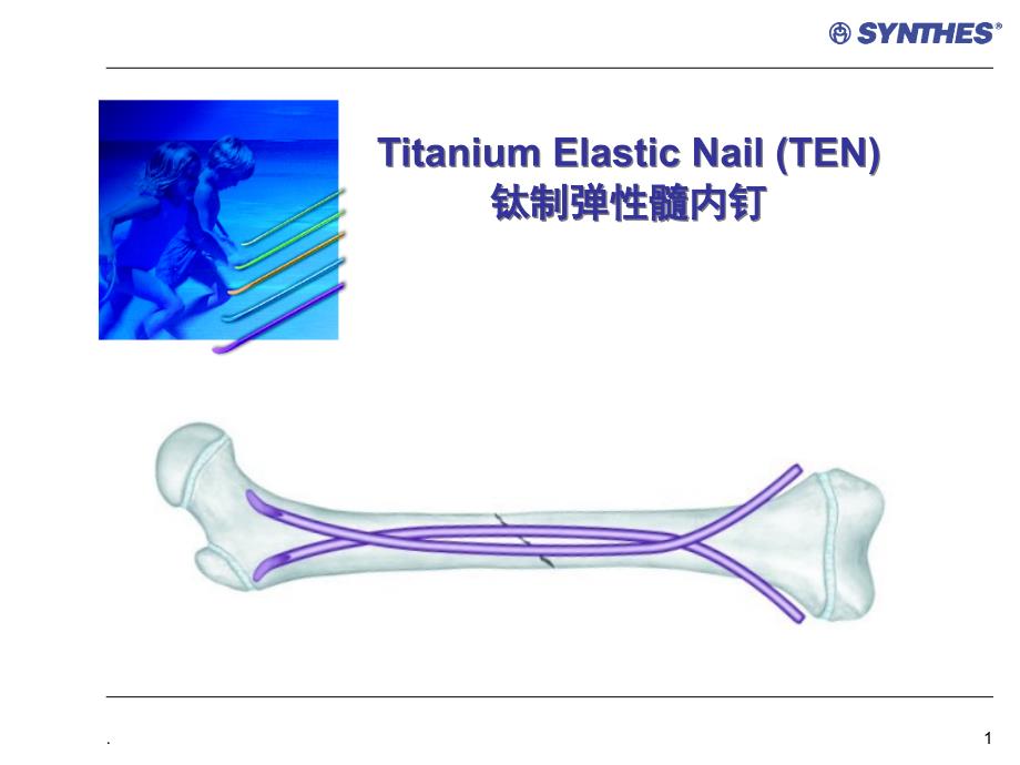 弹性髓内钉医学ppt课件_第1页