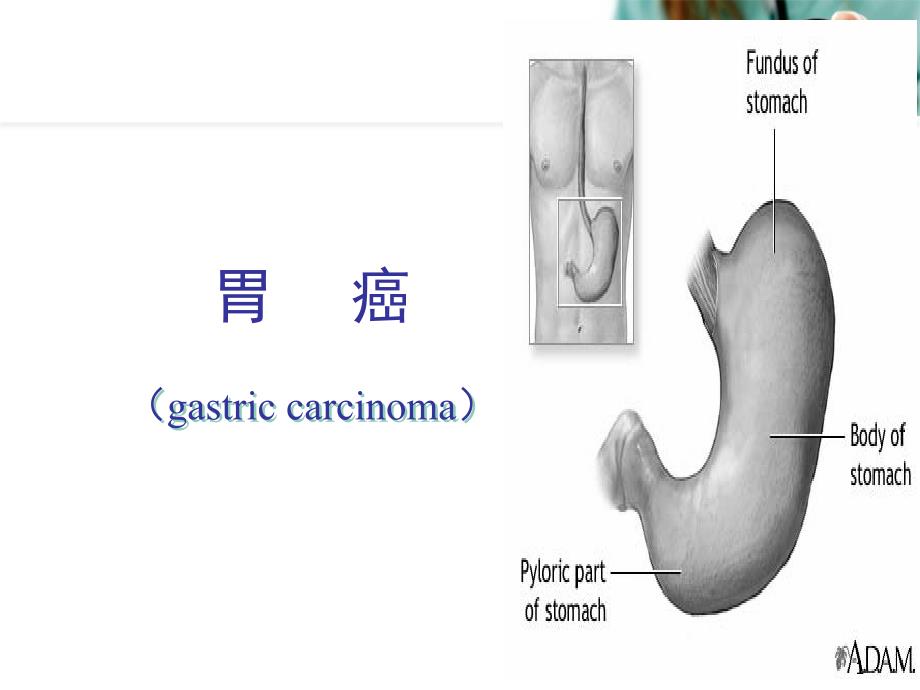 胃癌教学ppt课件_第1页