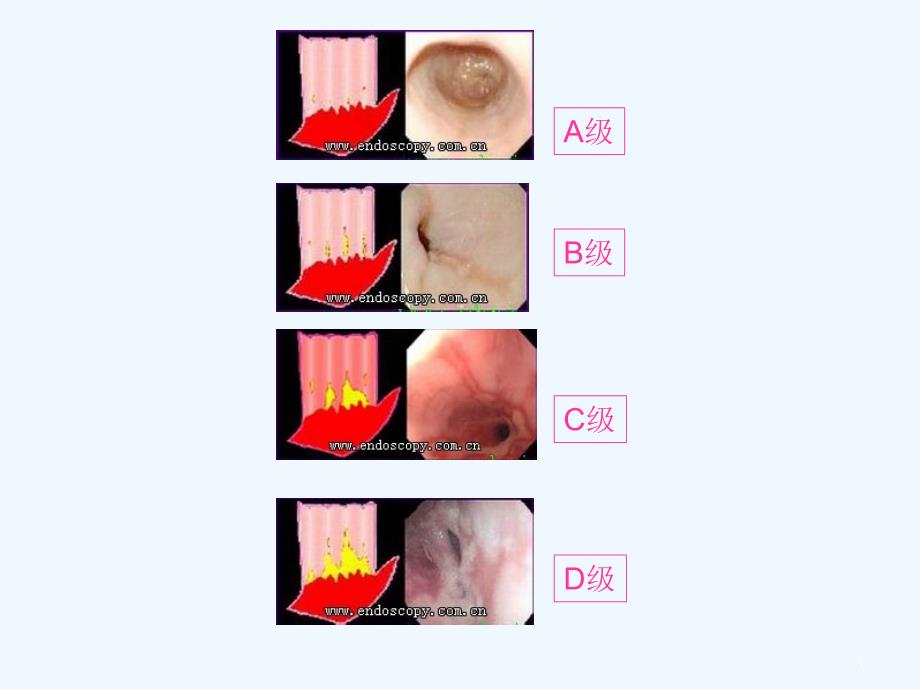 上消化道内镜诊断规范课件_第1页