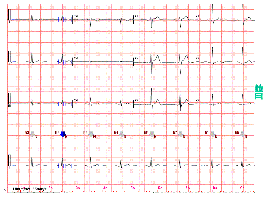 心电图常见正常和异常心电图图谱_第1页
