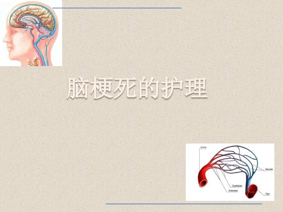 脑梗死的护理_第1页