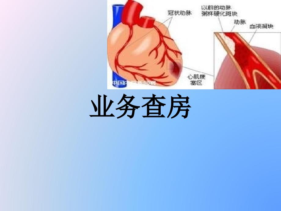 扩张性心肌病_第1页