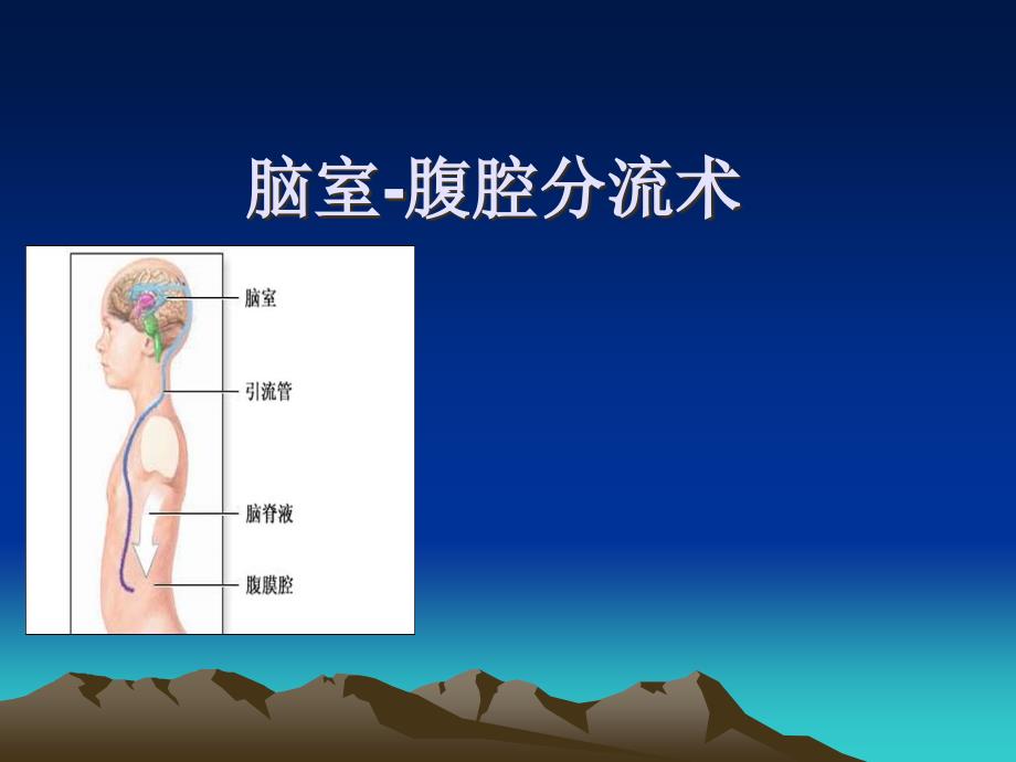 脑室腹腔分流术_第1页