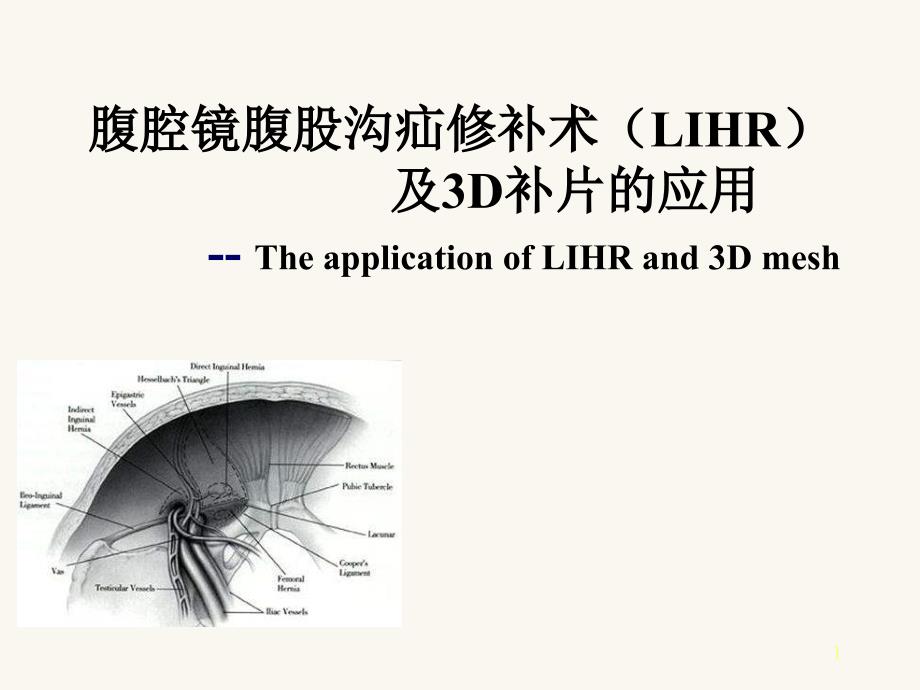 腹腔镜腹股沟疝修补术.ppt_第1页