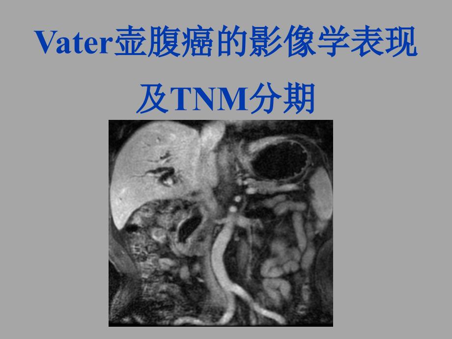 Vater壶腹癌的影像学表现及TNM分期_第1页